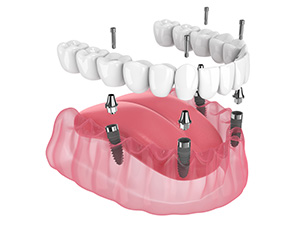 Full-arch teeth secured on four implants