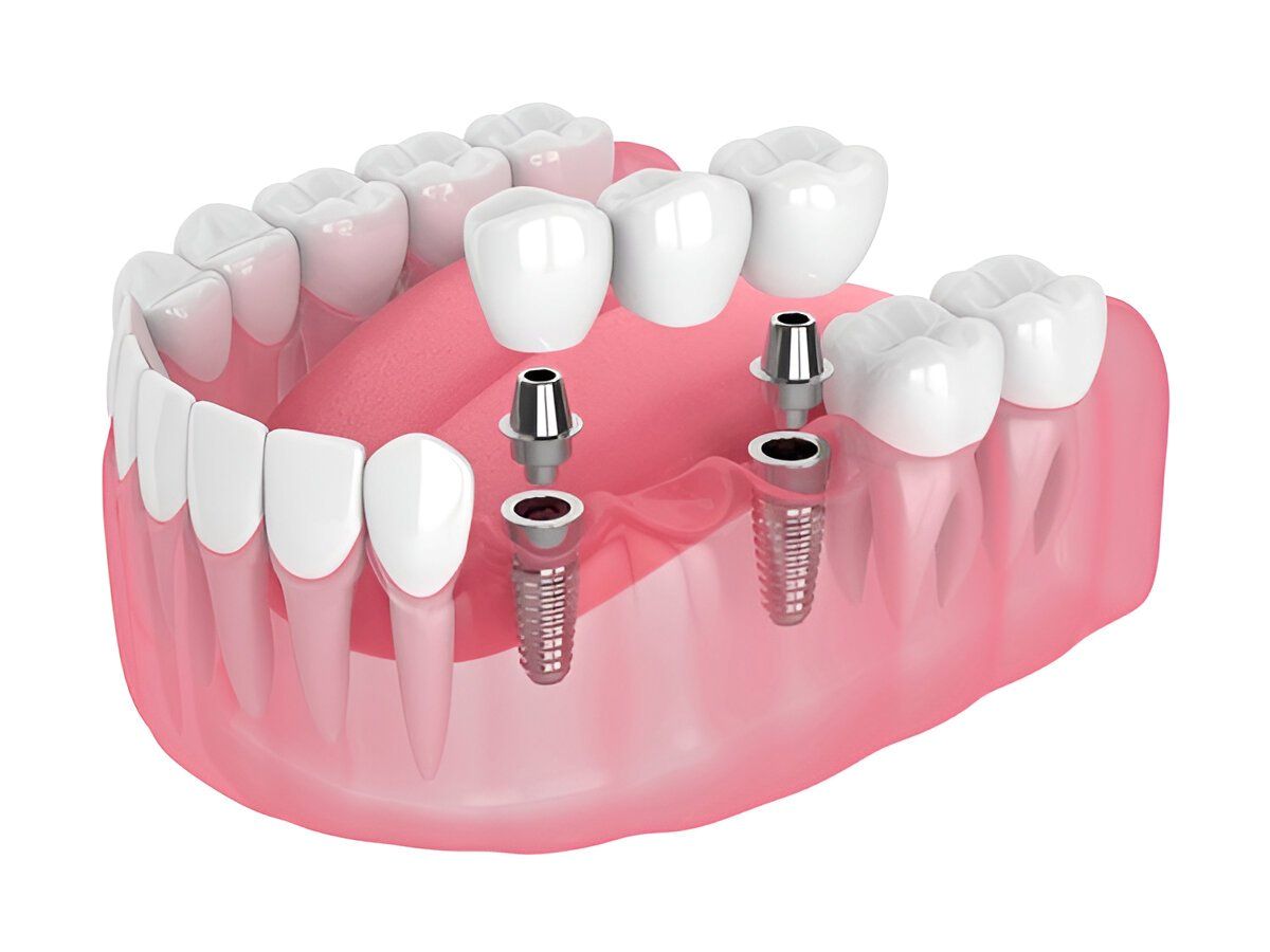 Implant-supported teeth anchored into the jaw