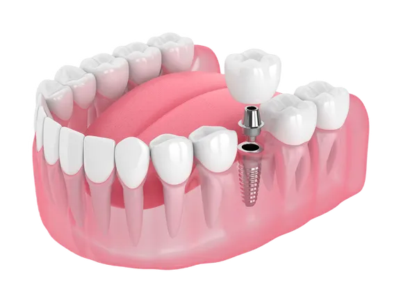 Single implant placed among healthy natural teeth